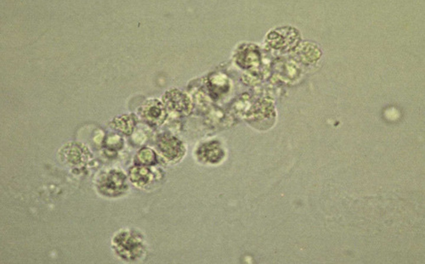 <p>appear as clear cylinders containing leukocytes. They are associated with infection or inflammation of the nephron. can be seen in cases of pyelonephritis and interstitial nephritis.</p>