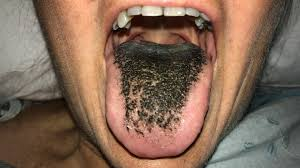 <p>overgrowth of bacteria in mouth</p><p>yellow→brown/black</p><p>hypertrophied+elongated papillae</p><p>on dorsum of tongue</p>