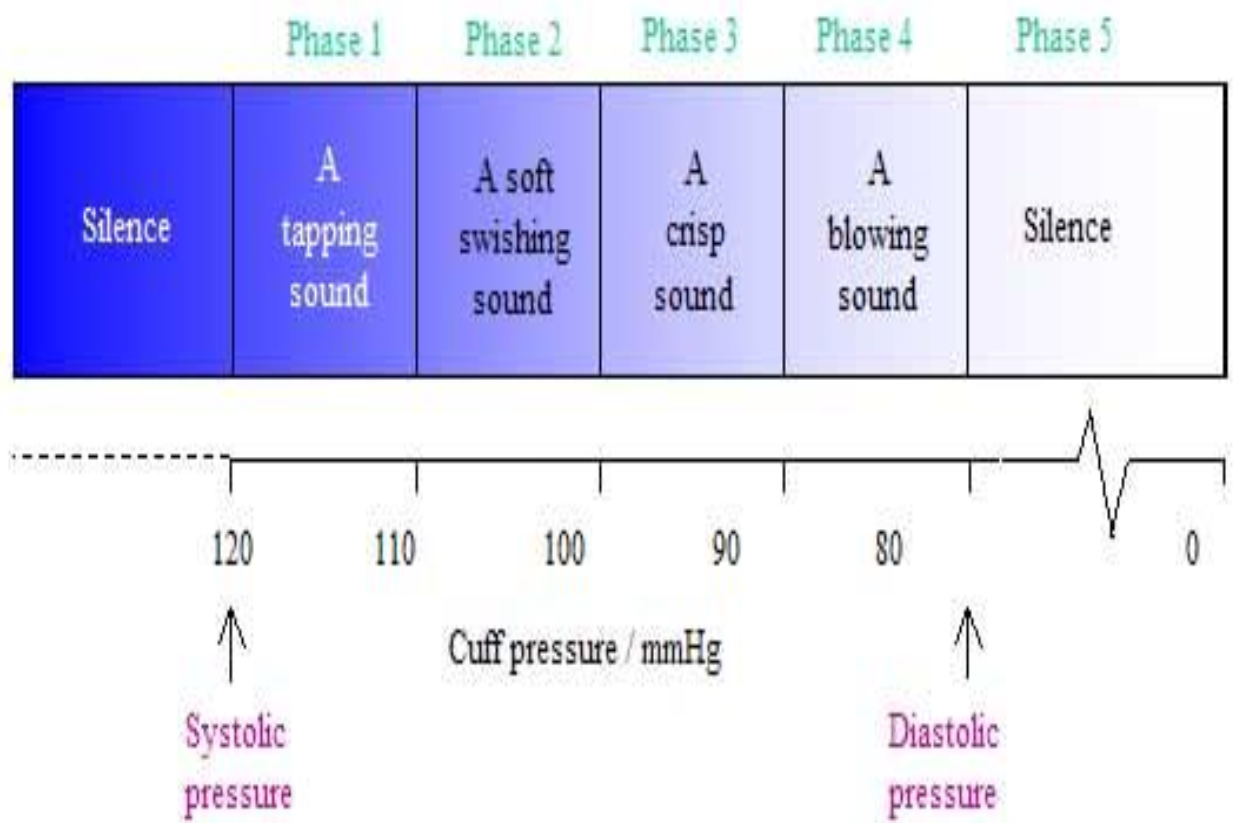 <ul><li><p>I = first noise, tapping, at least 2 in a row</p></li><li><p>II = whooshing noise</p></li><li><p>III = intense</p></li><li><p>IV = muffled sounds</p></li><li><p>V = disappearance of sound</p></li></ul><p></p>