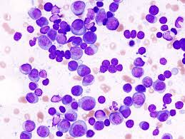 <p>multiple myeloma</p>