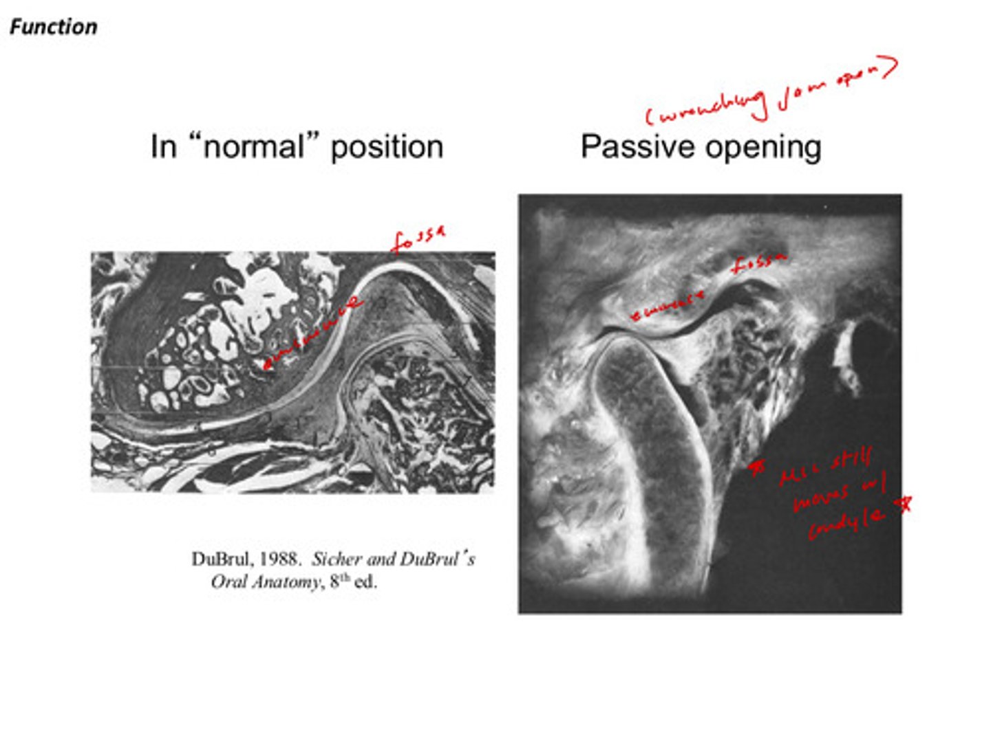 <p>during TMJ movement, the disc moves WITH the condyle</p>