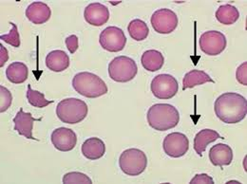 <p><strong>Esquistocito (célula fragmentada)</strong></p>