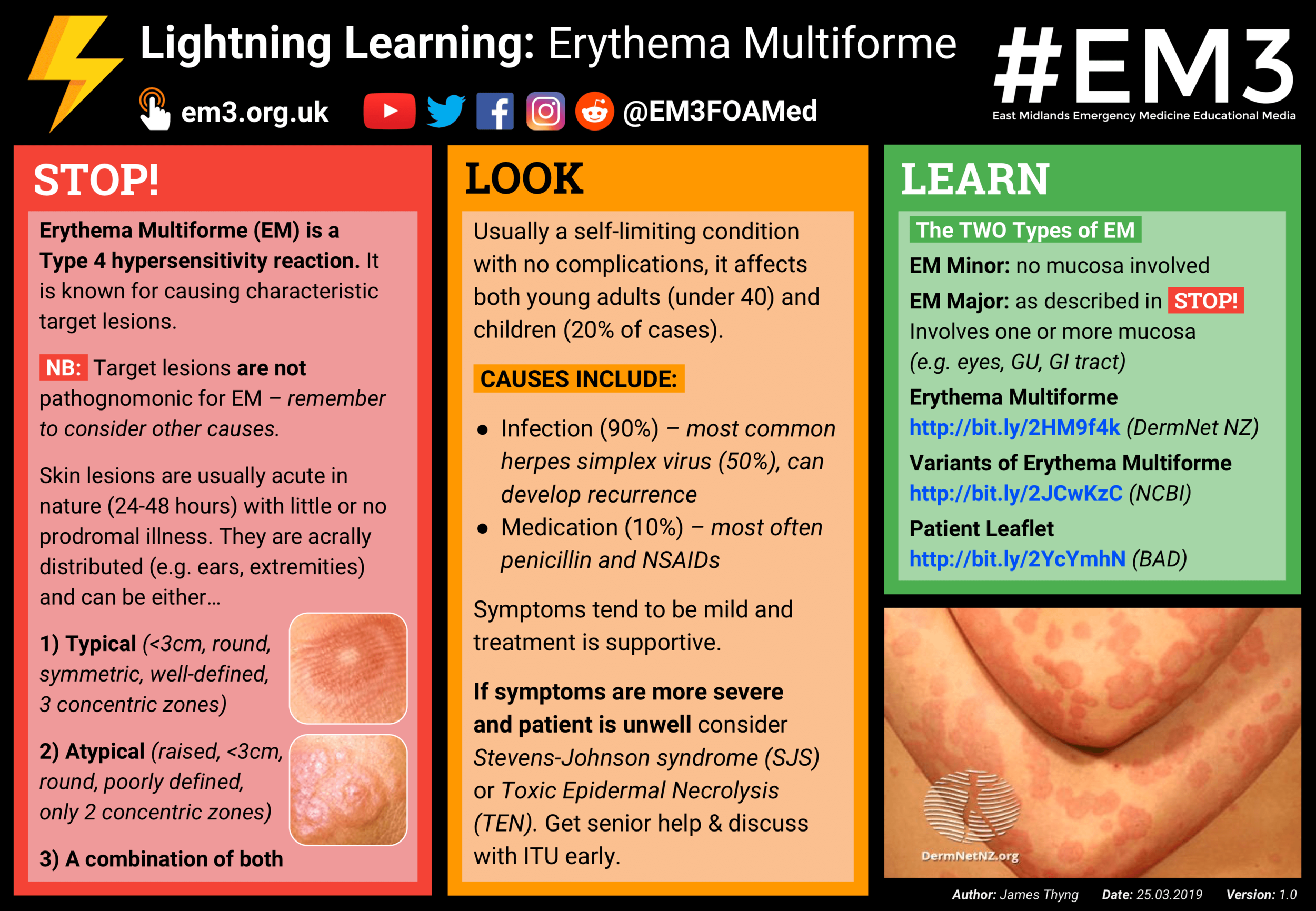 <p><u>EM minor:</u><br>PP: sharply marginated erythematous macules→raised+edematous over 1-2 days<br>ring of erythema forms→target shape</p><p>E: m. pneumonia</p><p>CM: <strong>orolabial herpetic outbreak 3-14 days before rash</strong><br><strong>no prodromal/flu-like sx</strong></p><p>P: self-limited<br>1-2 weeks<br>common recurrence</p><p><u>EM major:</u><br>PP: sharply marginated erythematous macules→raised+edematous over 1-2 days<br>ring of erythema forms→target shape</p><p>E: m. pneumonia</p><p>CM: <strong>influenza-like sx 1-2 weeks before cutaneous lesions</strong></p><p>P: 5% mortality rate<br>uncommon recurrence</p><p><u>SJS:</u><br>PP: EM like skin lesions<br><strong>cover 10% BSA or less</strong><br><strong>mucosal involvement<br>-oral<br>-occular<br>-genital</strong></p><p>E: adverse reaction to mx<br>-sulfonamides<br>-anticonvulsants</p><p><u>TEN:</u><br>PP: <strong>cover 30% or greater BSA</strong><br><strong>skin sloughs off body</strong></p><p>E: adverse reaction to mx<br>-sulfonamides<br>-anticonvulsants</p><p>DX: clinical assessment<br>biopsy→does not distinguish<br>neutropenia<br>BUN (high→bad prognosis)</p><p>TX:<br><u>EM:</u><br>NP:<br>stop mx<br>tx underlying cause</p><p>MX:<br>antihistamines<br>mild topical steroids</p><p><u>SJS/TEN:</u><br>admit to hospital<br>TEN→burn unit</p>