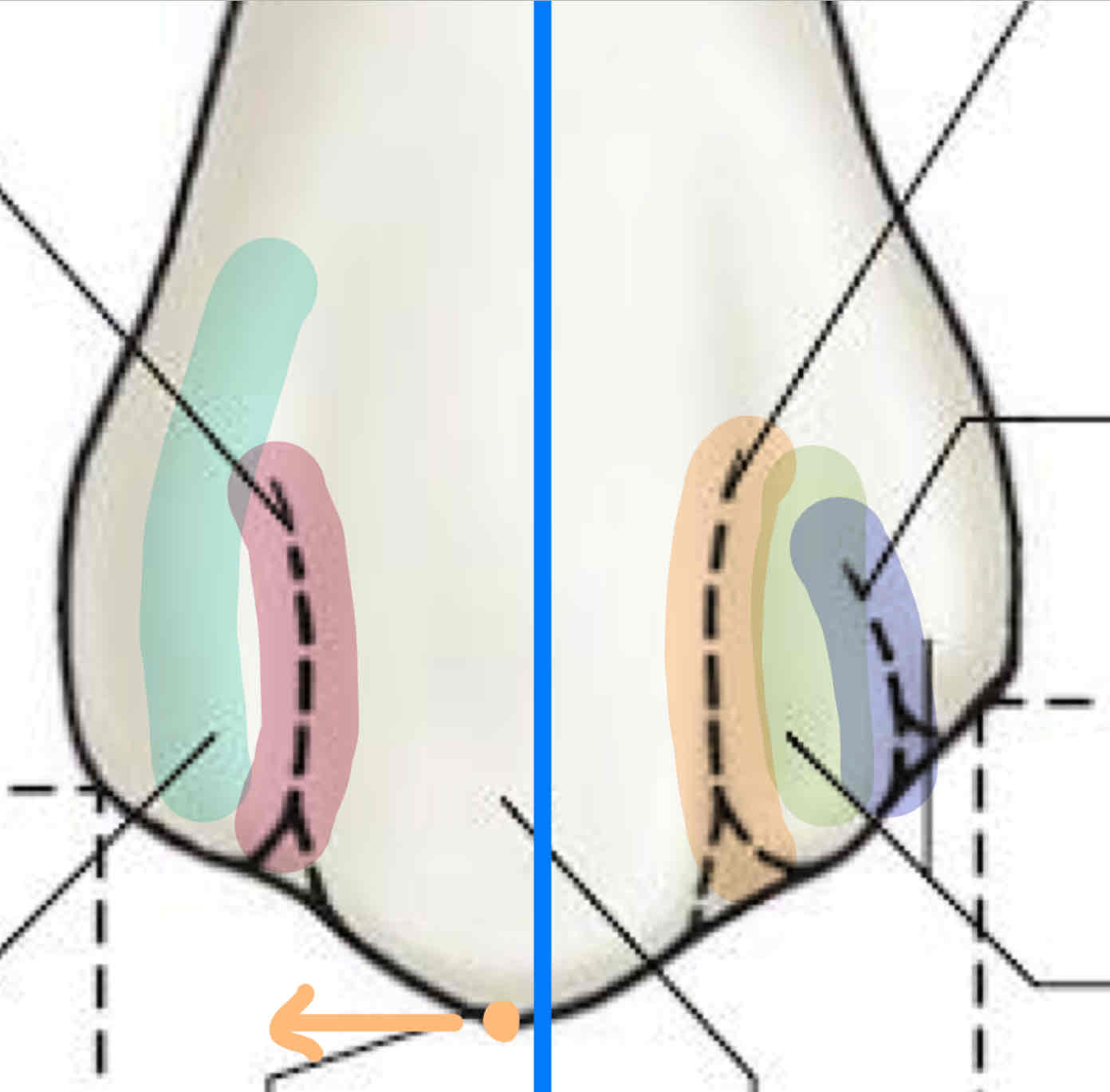 <p>what are the three developmental lobes of the labial surface?</p>