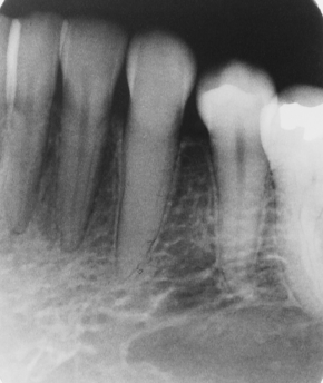 <p>which tooth is nonvital</p><p>24</p><p>23</p><p>22</p><p>21</p>