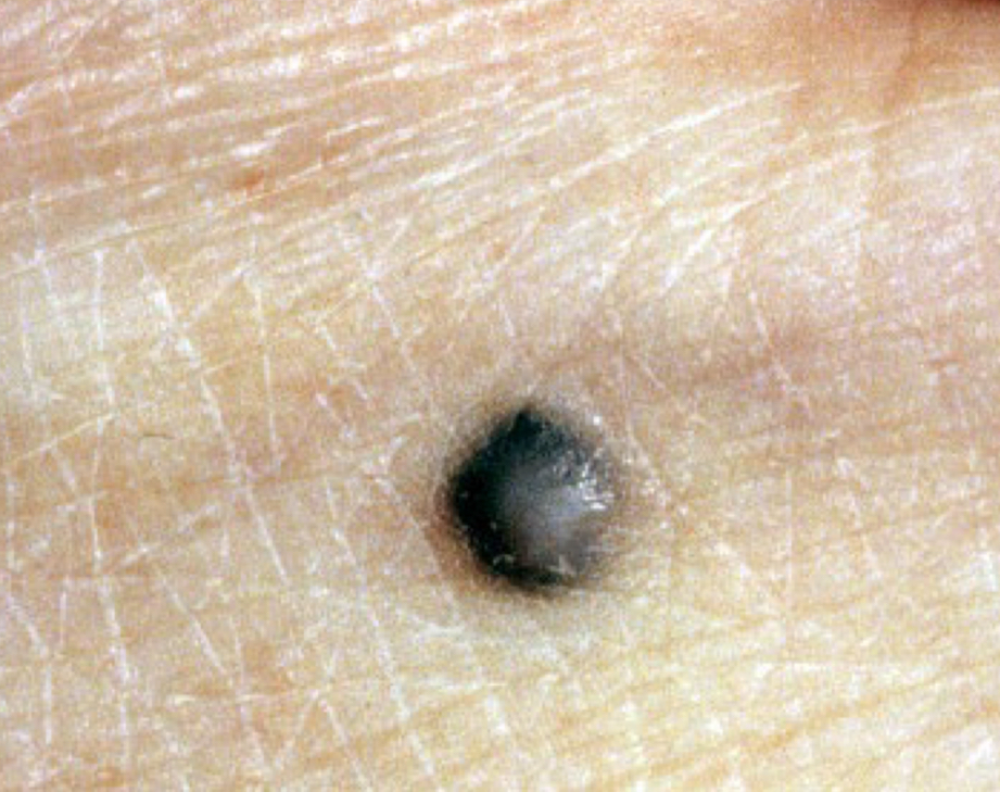 <p>what type of color change and condition is depicted</p>