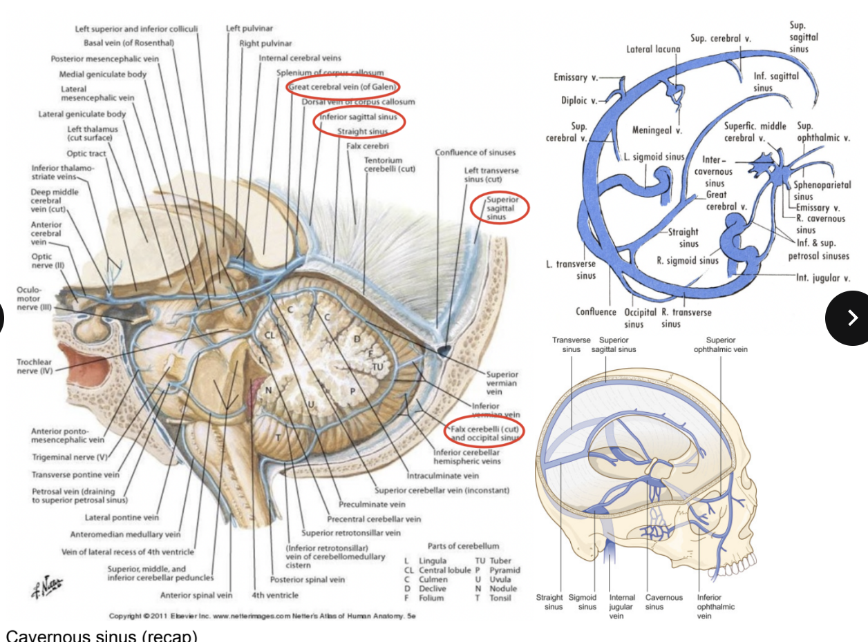 <ul><li><p>Form in between the endosteal &amp; meningeal layer — lined by the endothelium — found where the dura mater attaches to the skull or along its free margins</p></li><li><p>Wall – made of dura mater lined by endothelium&nbsp;</p></li><li><p>Venous sinuses drain the deep &amp; superficial veins of the brain into the sigmoid sinus into the internal jugular vein&nbsp;—&nbsp;Before final drainage they are in communication with outside via emissary veins&nbsp;</p><ul><li><p>Superior sagittal sinus</p><ul><li><p>Where the falx cerebri attaches to the skull</p></li></ul></li><li><p>Inferior sagittal sinus —</p><ul><li><p>At the level of the free margin of the falx cerebri</p></li></ul></li><li><p>Straight sinus —</p><ul><li><p>Where the tentorium attaches to each other, in front of the transverse groove, attaches in back to transverse</p></li></ul></li><li><p>Transverse sinus — where the tentorium attaches to the transverse groove</p></li><li><p>Sigmoid sinus —</p><ul><li><p>In the sigmoid groove which drains (from the transverse sinus) in the internal jugular vein, at the level of the jugular foramen</p></li></ul></li><li><p>Superior &amp; inferior petrous sinuses — continue forward from sigmoid sinus along petrous portion of temporal bone, connecting to cavernous sinus</p></li><li><p>Cavernous sinus —</p><ul><li><p>On the sides of the sella turcica</p></li></ul></li><li><p>Occipital sinus —</p><ul><li><p>Where there is a lamina of dura mater that inserts in between the 2 cerebellar hemispheres (cerebellar falx or falx cerebri) and on the other part, attaches on the inferior part of the straight crest (going down from transverse sinus)</p></li></ul></li></ul></li><li><p>Confluence of the sinuses —</p><ul><li><p>Where the transverse, occipital, straight, &amp; superior sagittal sinuses come together</p></li></ul></li></ul>