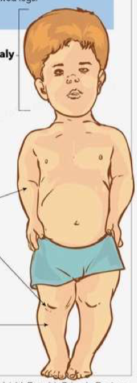 achondroplasia 