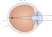 <p>Is this Myopia or Hyperopia? How can it be corrected?</p>