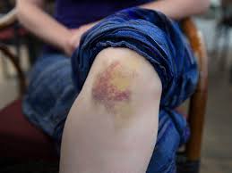 <p>bruising </p><ul><li><p>usually trauma related</p></li></ul><p></p>