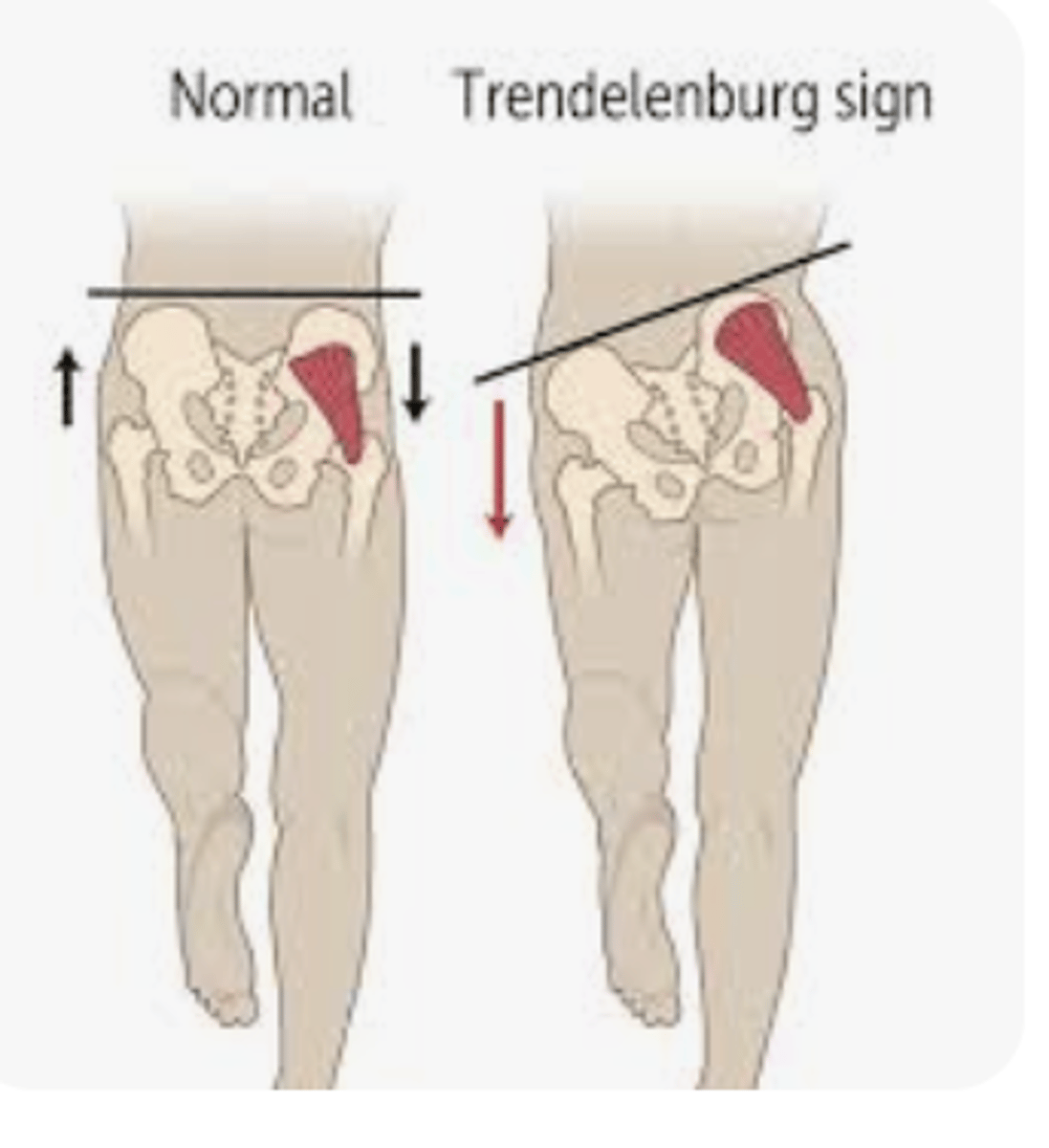 <p>Gluteus medius endurance weakness</p><p>C/L hip drop</p>