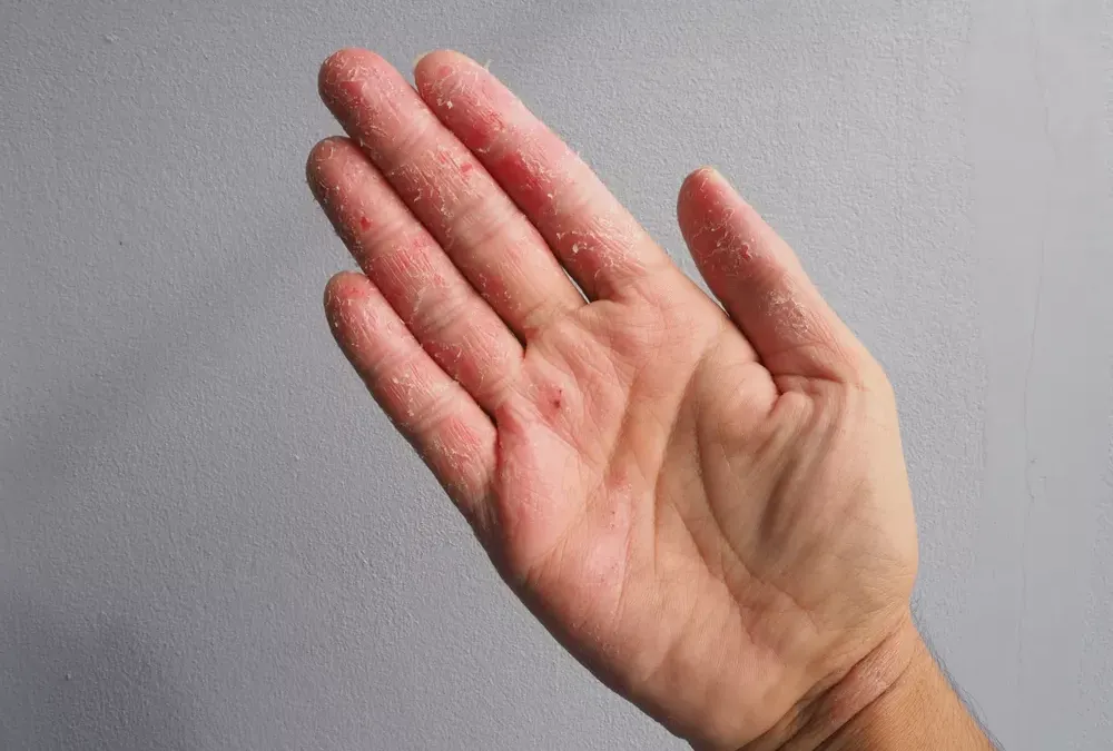 <p>perdre ses écailles<br>ou<br>peau se détachant en squames<br>ou<br>roches se délitant superficiellement</p>