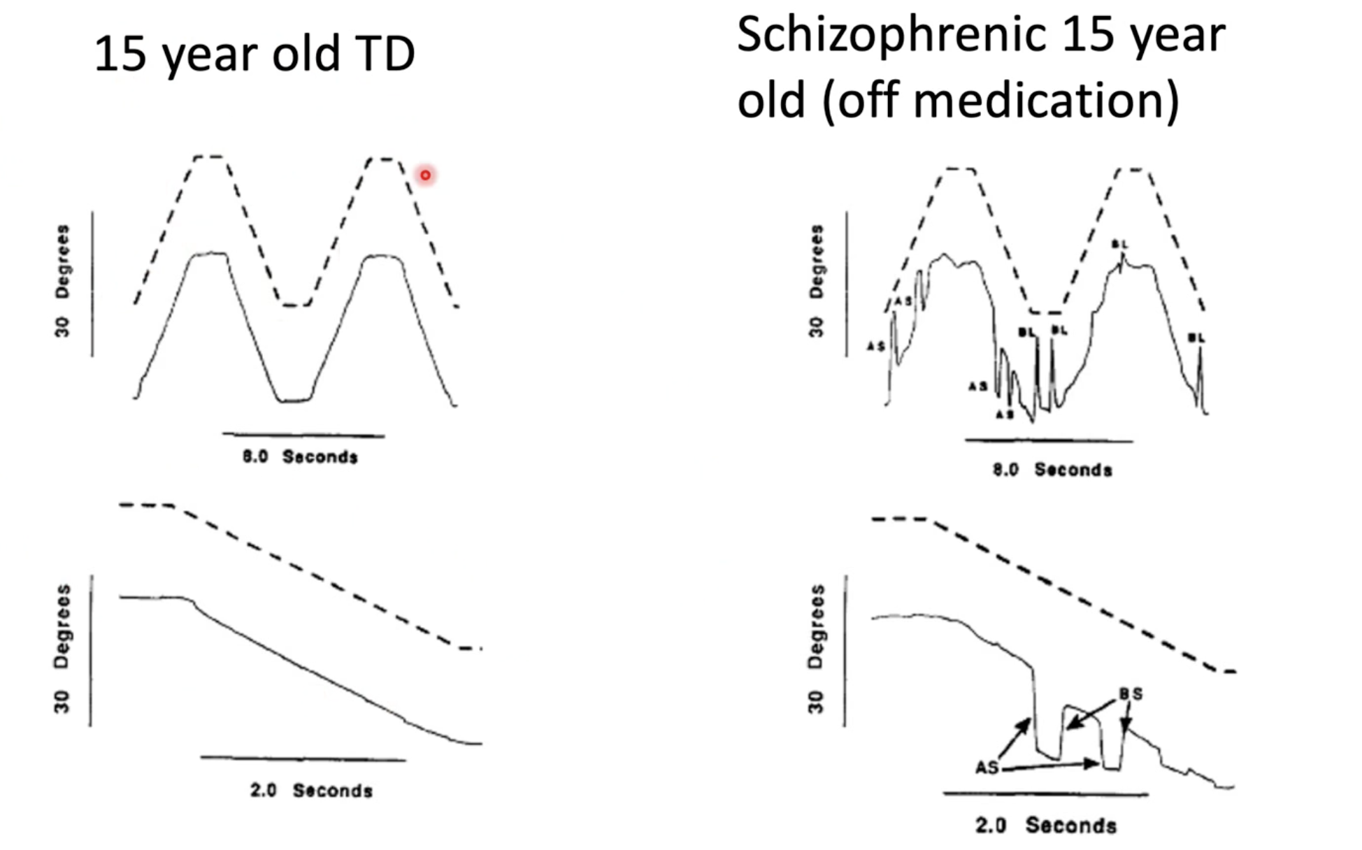 <p>There are significant differences</p><ul><li><p>On the left, you can see that the TD child is far more accurate in smoothly following the target. Apart from maybe a tiny catch-up saccade when the target first changed direction, it is largely smooth</p></li><li><p>On the right, the eye movements of the schizophrenic child is sporadic and they spend less time fixated on the target. There are significantly more intrusive saccades (anticipatory and catchup). They really can’t smoothly track the target.</p></li></ul><p></p><p>Findings from this study contributed to existing support that there is significant continuity between adult and childhood onset forms of schizophrenia</p>