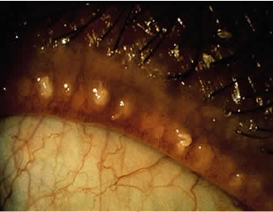 <p>> Meibomian gland Dysfunction</p><p></p><p>MGD -<strong> thickened secretions</strong> which block duct</p>