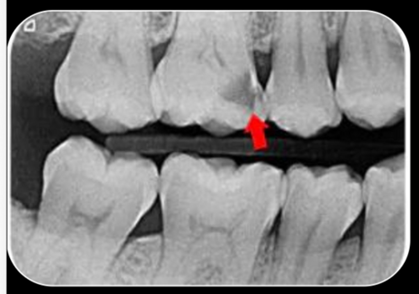 <p>What are the radiographic findings on #3?</p>