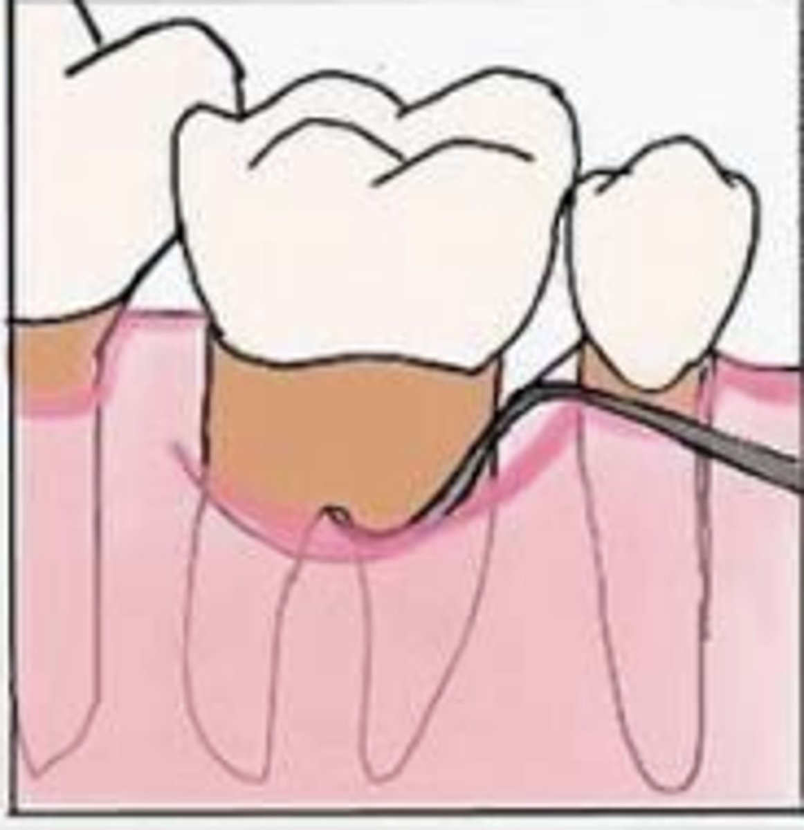 <p>Communication from one furcation to another (through-and-through lesion)</p>