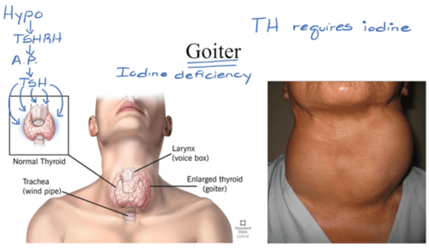 <p>- enlarged thyroid gland b/c lack of iodine</p><p>- can't make TH, but is still receiving signals from hypothalamus</p><p>- need to release TH, dependent on it</p><p>- continues to be stimulated &amp; it gets bigger</p>