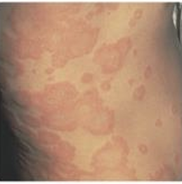 <p>REDDENED LOCALIZED COLLECTION OF EDEMA FLUID. IRREGULAR IN SHAPE; SIZE VARIES</p>