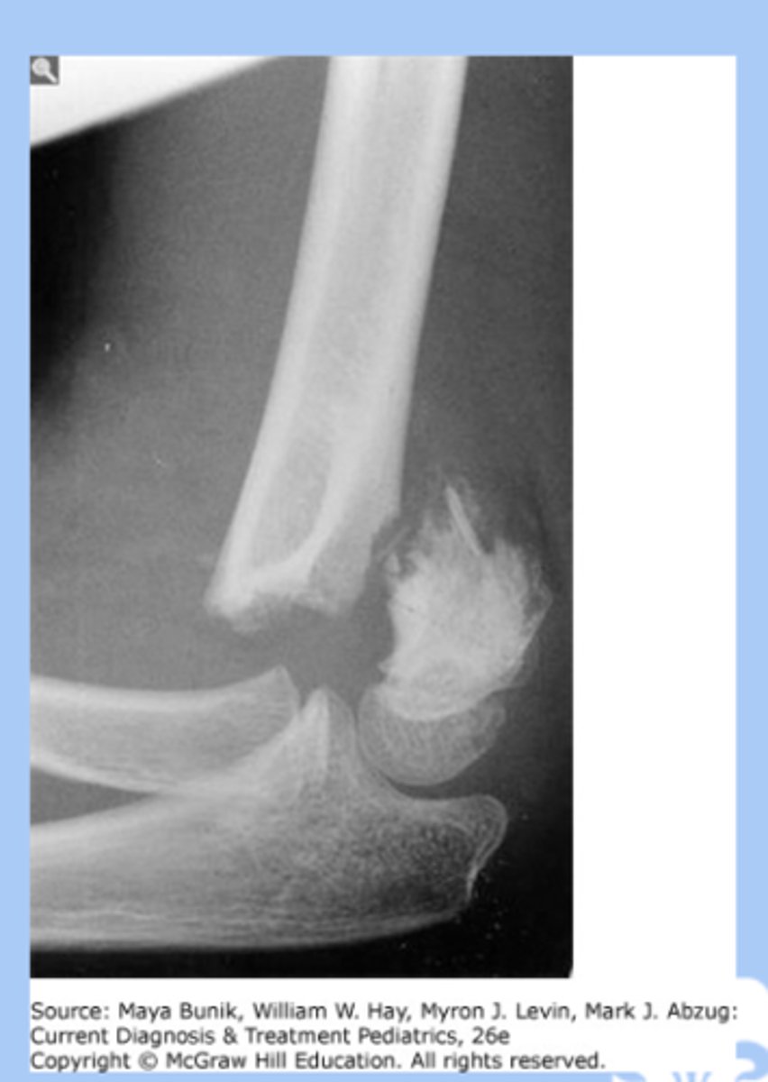 <p>-superior to the humeral condyles </p><p>-children 3-6yr </p><p>-proximity of the brachial artery in the distal arm creates a potential danger when dealing with these</p><p>-severe swelling </p><p>-tx: casting, surgery </p>