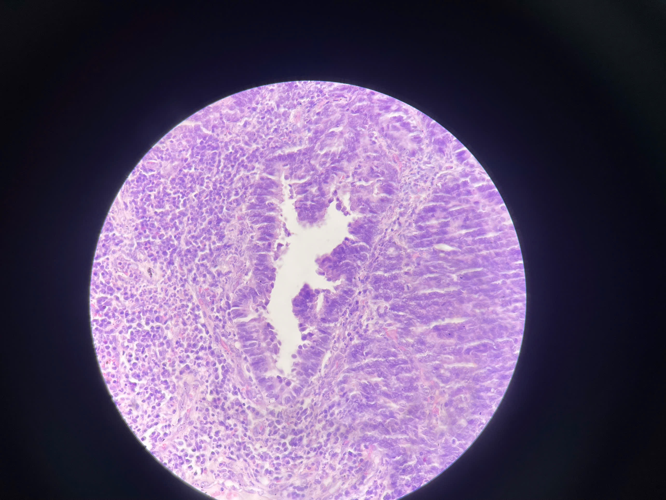 <p>Polyp tuyến LTC (3)</p>