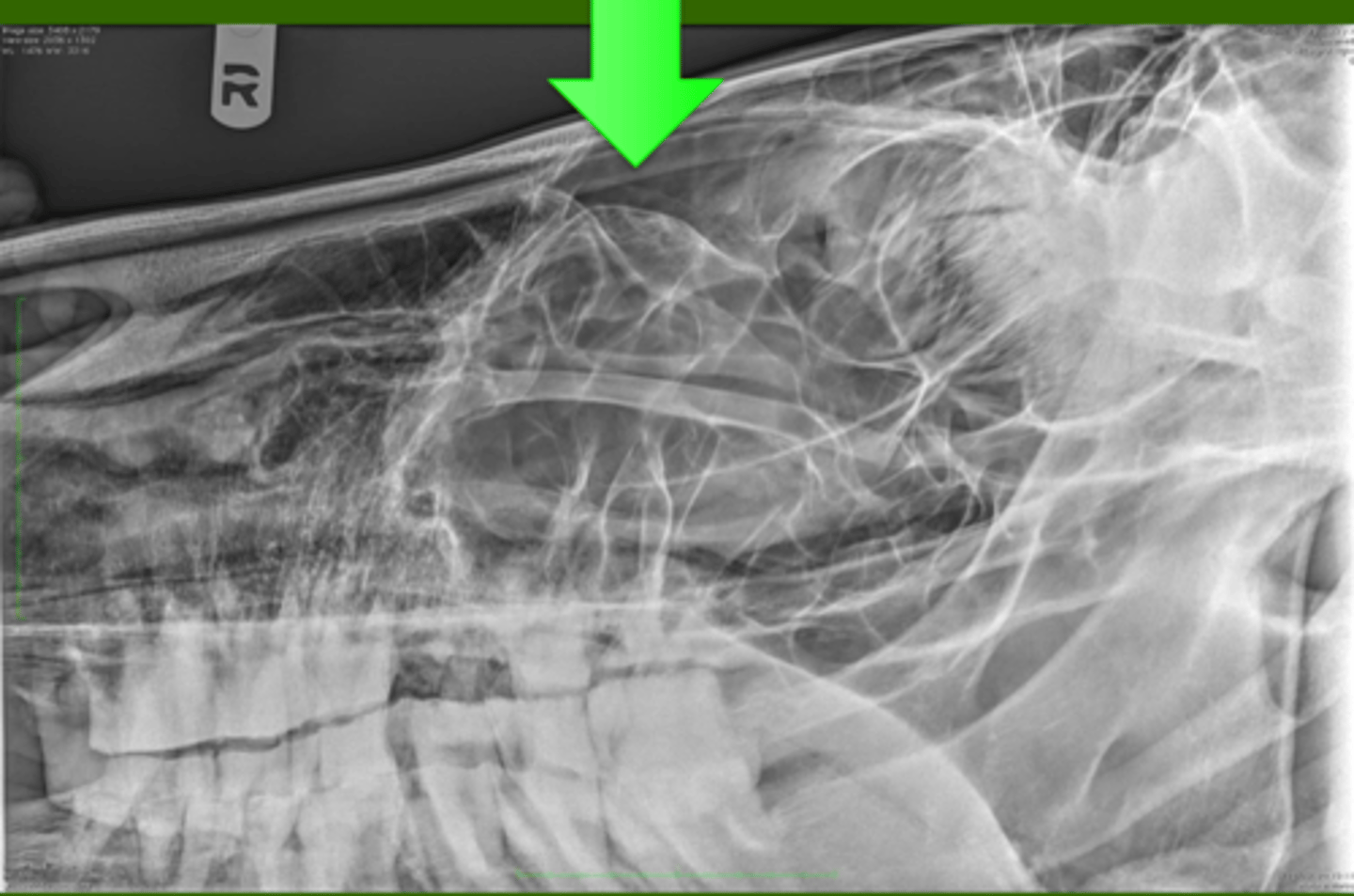 <p>Identify the pathology?</p>