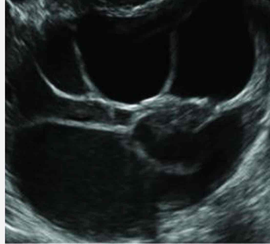 <p>huge multiple thin septations with low level echoes</p><p>Age: 13-45 yo</p>