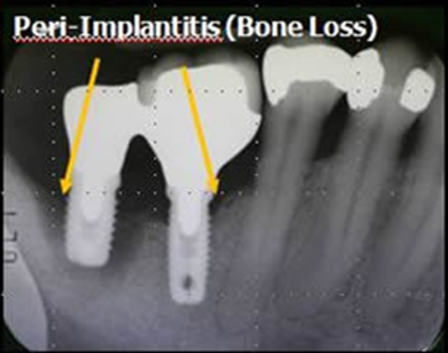 <p>- Infection with suppuration and inflammation of the soft tissues surrounding an implant, with clinically significant loss of peri-implant crestal bone after the adaptive phase</p><p>- Tissues will appear red and swollen, bleed on gentle palpation or probing, with suppuration</p><p>- May be an increase in probing depth around the implant and the implant threads may be detectable</p><p>- Recession of the surrounding mucosa can occur, exposing the threads</p><p>- May also experience pain around the implant (usually only occurs during episodes of acute infection)</p>