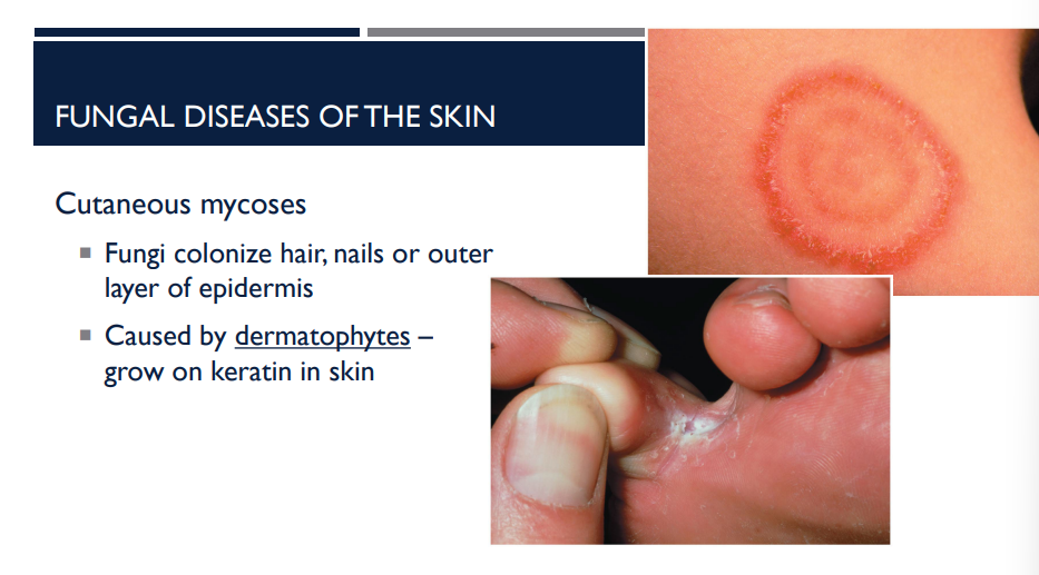<p>Describe the general type of fungal infection (which cause fungal disease of the skin), cutaneous mycoses. </p>