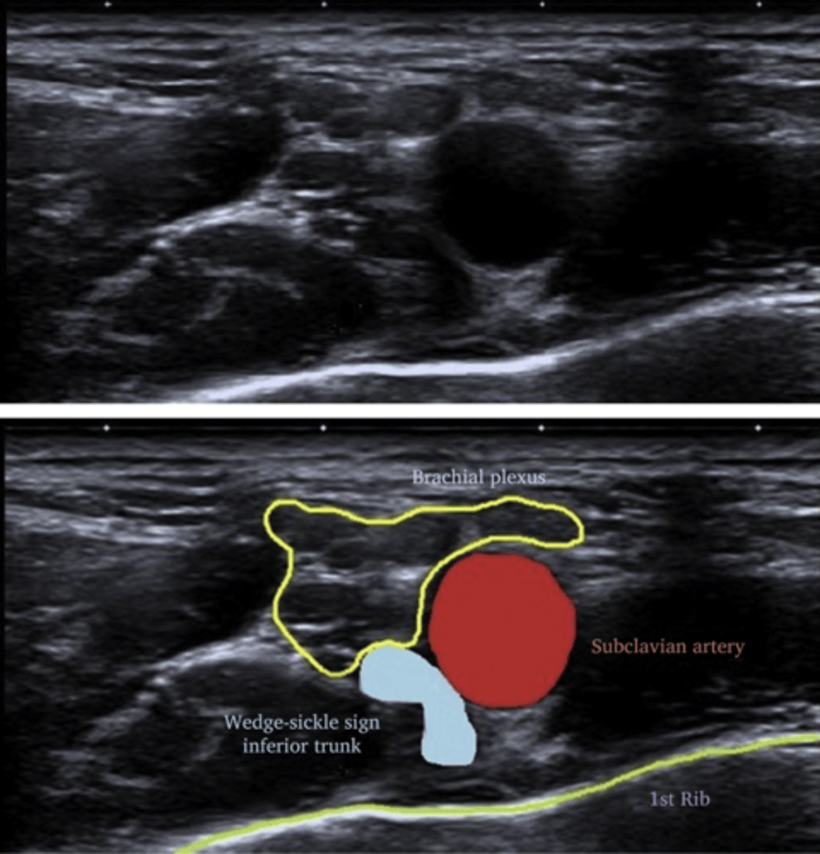 <p>Doppler ultrasound to evaluate subclavian vein for obstruction or thrombosis</p>