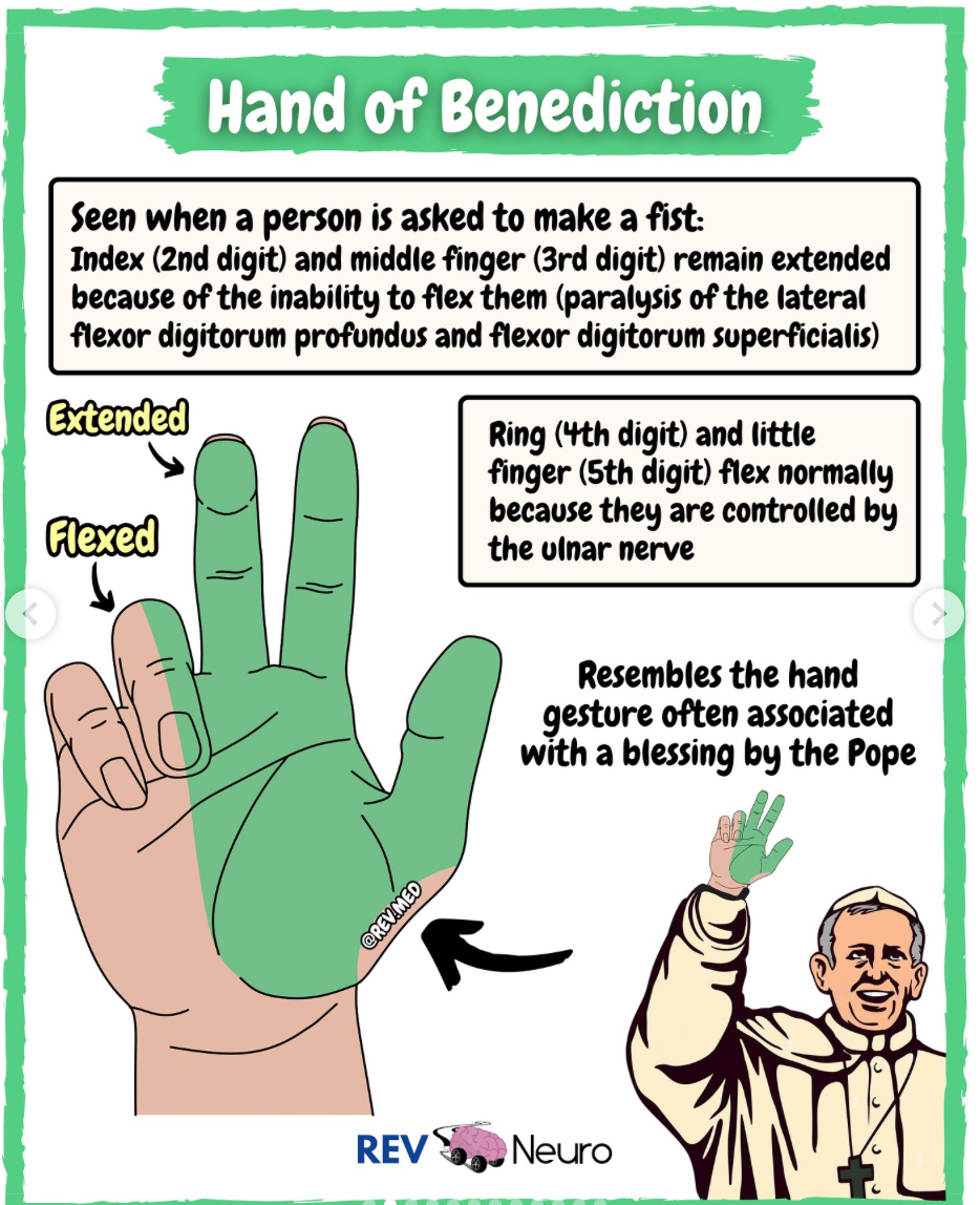 <p>(proximal median nerve)</p><p>~remember it is higher median nerve injury sign because pope’s hand is for higher God</p><p>-Ape hand at rest</p><p>-When client tries to make a fist only ring and pinky flex since there is a loss of MCP flexion of thumb, index, middle. First three digits can become hyperextended<br><br>OT int: dorsal protection splint, wrist at 30flex, elbow 90fex</p>
