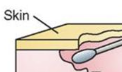 <p>the tissue under the edges of a wound becomes eroded, resulting in a pocket or space beneath the skin</p>