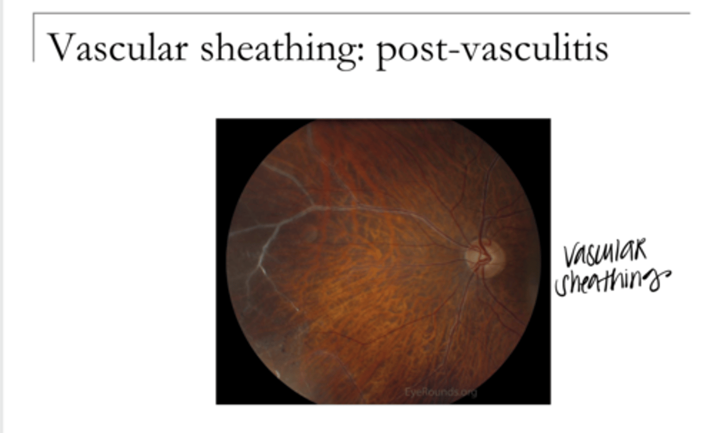 <p>What can be present post-vasculitis in the retina?</p>