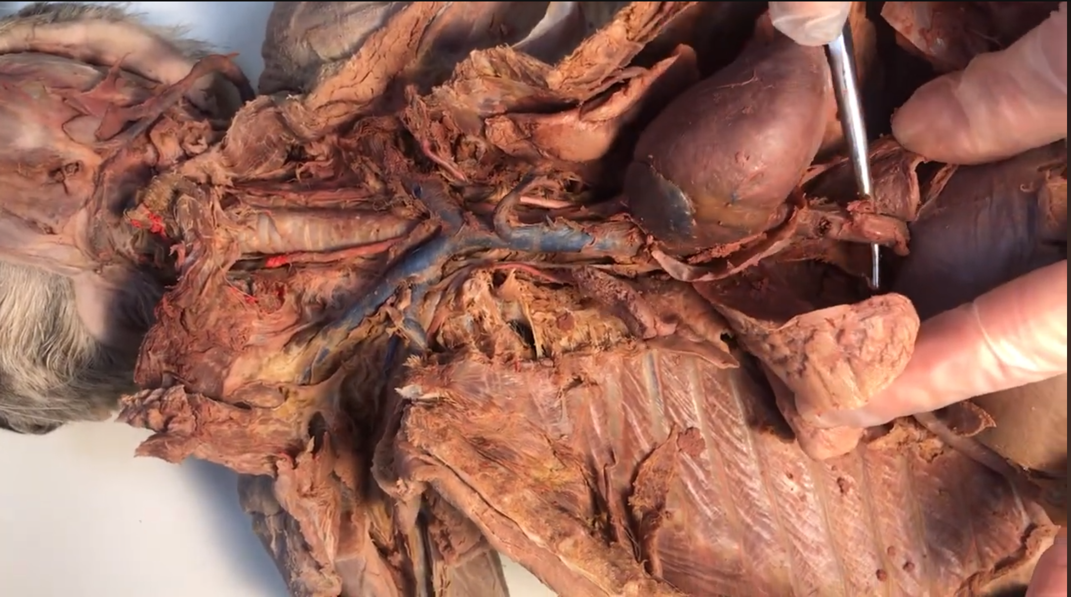 <p>What vein is this</p>