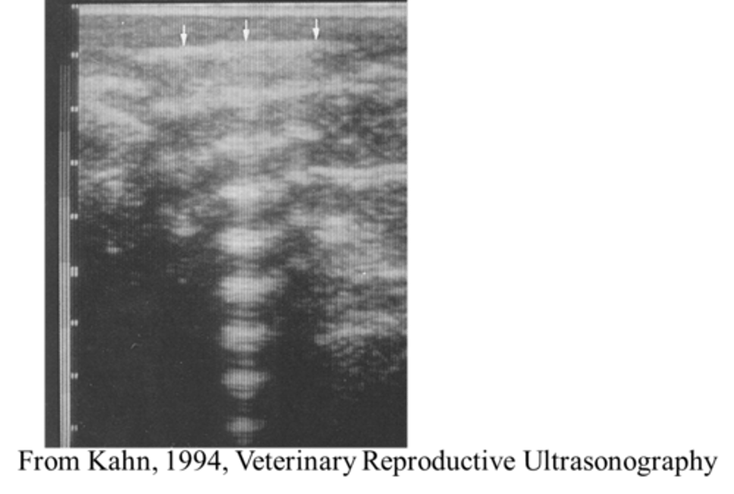 <p>What ultrasound artefact is seen here?</p>