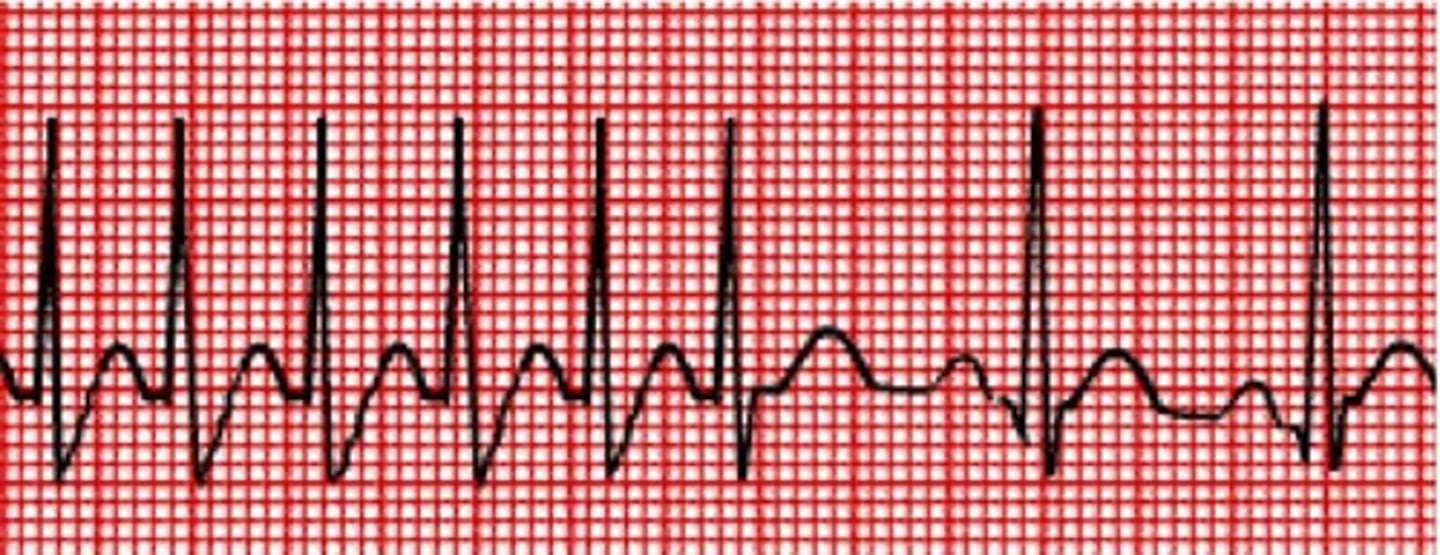 <p>(n.) a sudden outburst; a spasm, convulsion</p><p>(SYN: fit, seizure)</p>