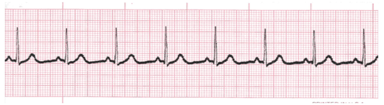 <p>What is the rhythm?</p>