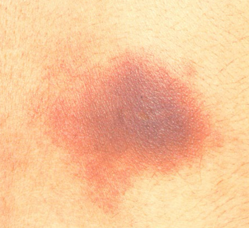 <p>what type of color change and condition is depicted</p>