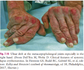 <p><strong>Ulnar Drift / Bowstringing effect (Seen in late stage RA)</strong></p>