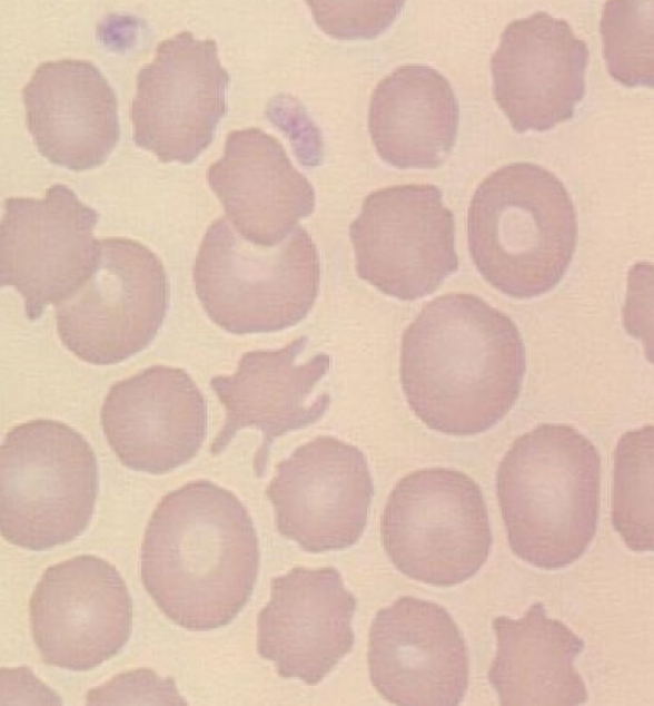 * irregular spicules
* Altered lipid:cholesterol
* causes: Hepatopathy, Hemangiosarcoma, Glomerulonephritis, Lymphoma, DIC, Young goats & cattle