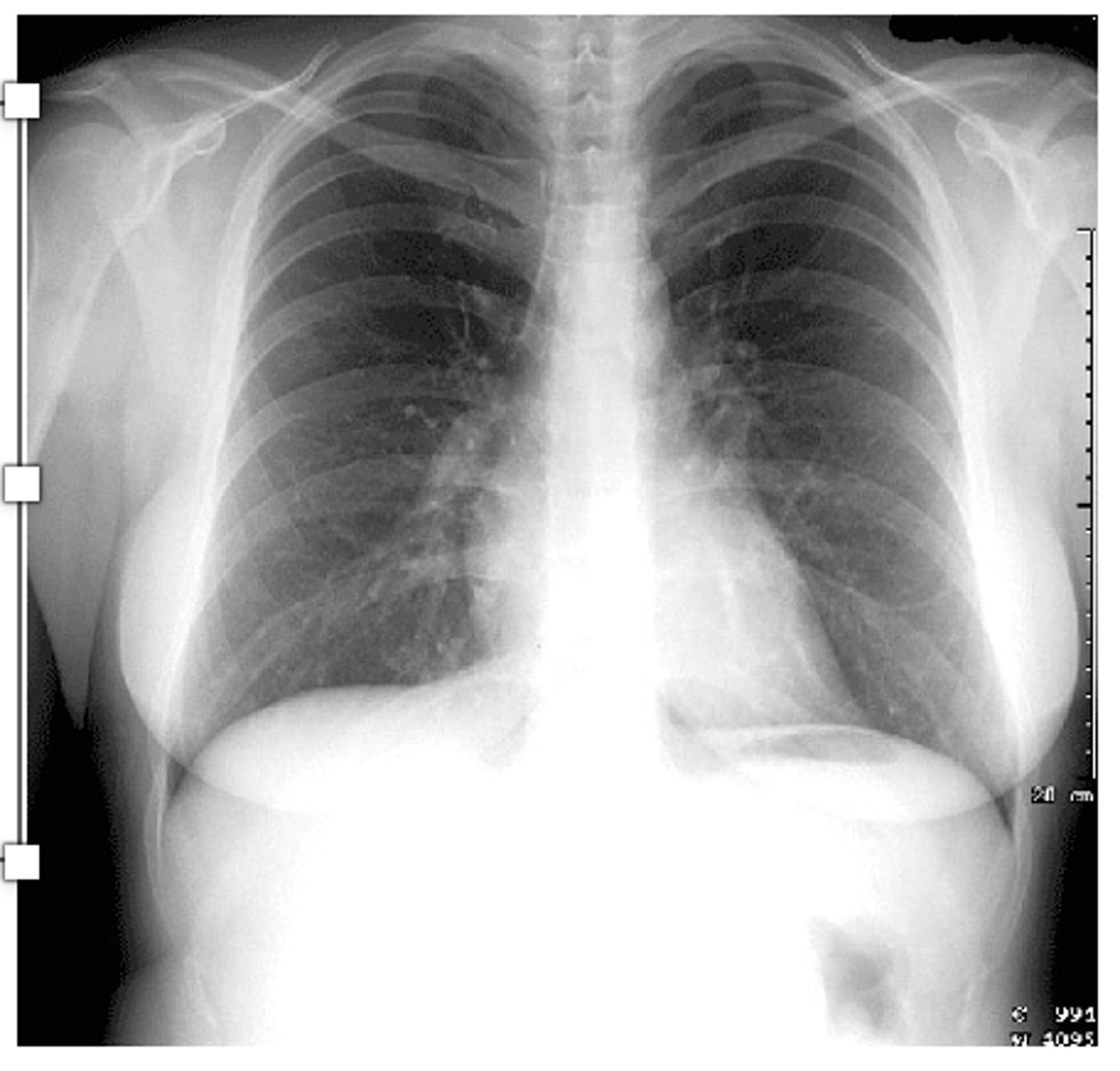<p>visualization of the vessels to at least the peripheral 2/3 of the lung.</p>