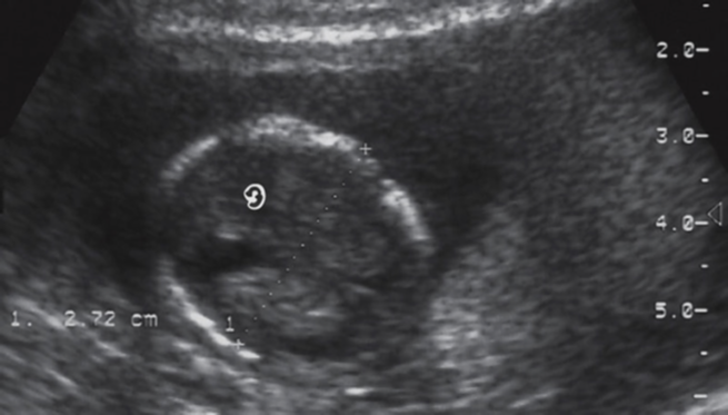 <p>difficult to see landmarks accurately (picture is week 14) </p><ul><li><p>measure at level of choroid plexus in these cases </p></li></ul>