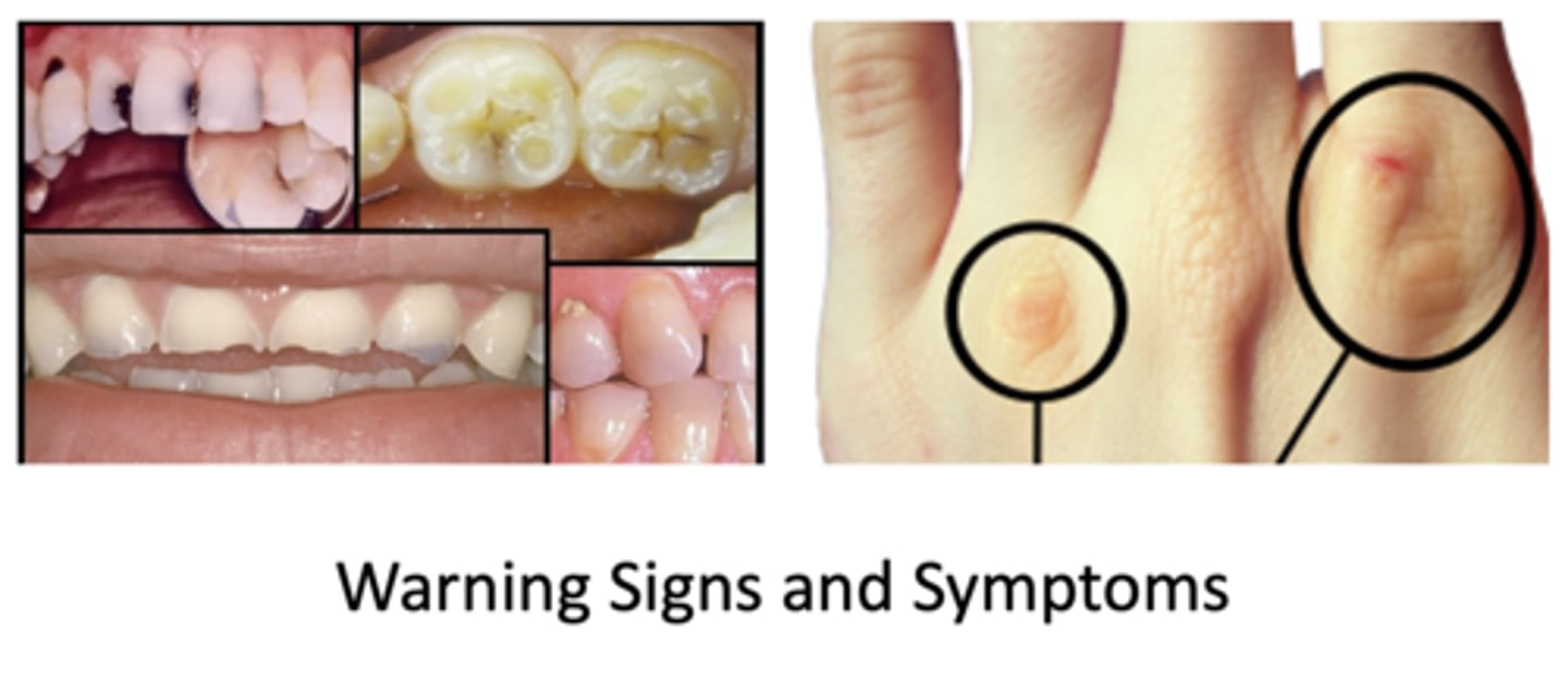 <p>- Russel's signs (sores/scars on knuckles/hands)</p><p>- Dental erosion</p>