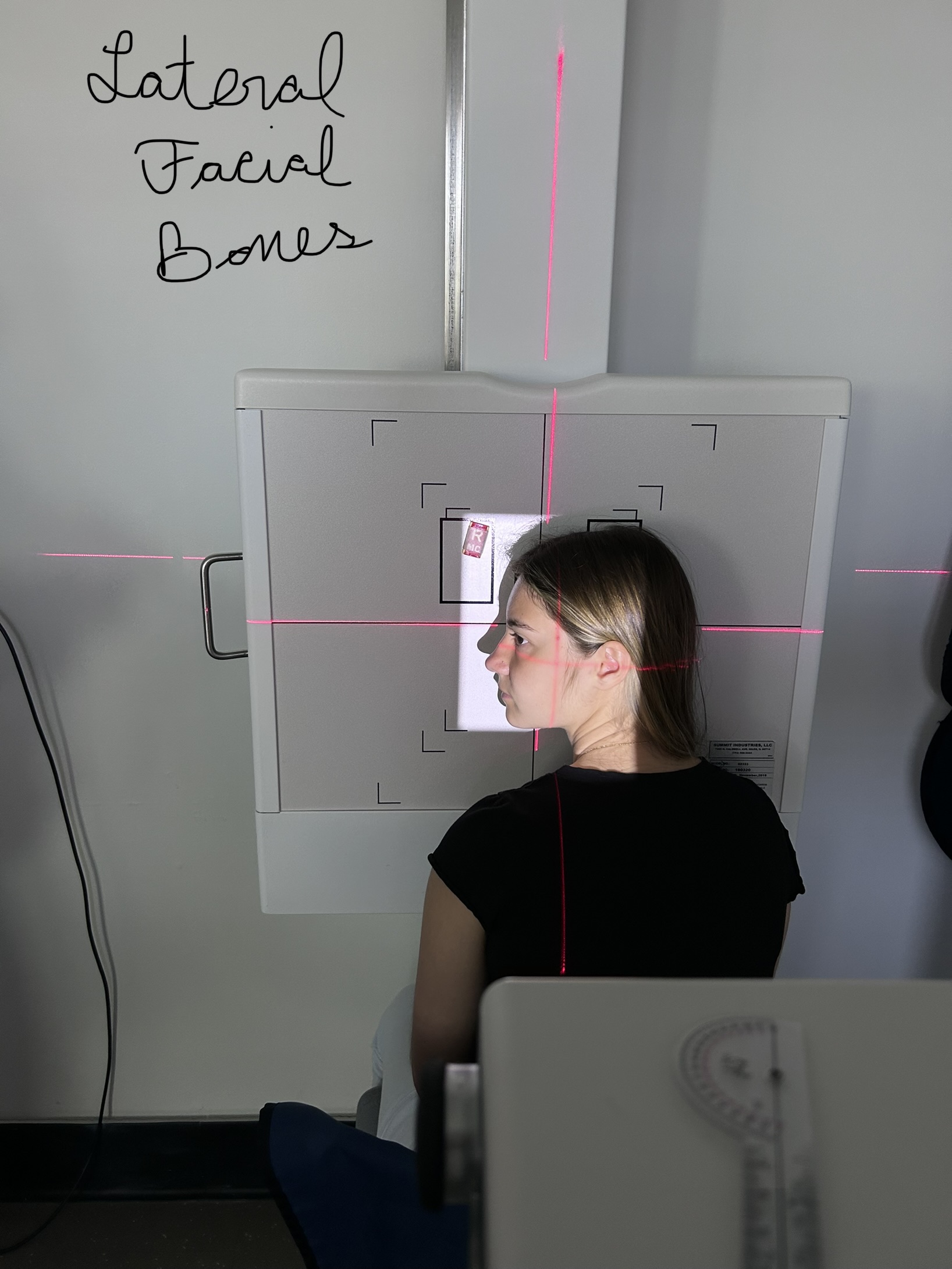Lateral Facial Bones