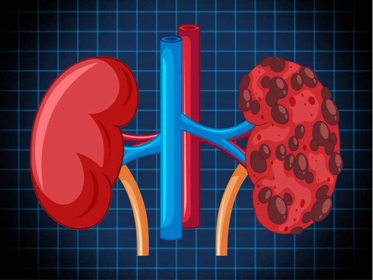 <p><strong>A 34-year-old man has been taking up to 2400 mg of ibuprofen per day following a motor vehicle accident several months ago and consequent chronic pain. He has recently been diagnosed with chronic analgesic nephritis as a result of his high analgesic intake. The man is surprised at the diagnosis stating, “I thought that taking too many drugs hurts your liver if anything, not your kidneys.” What is the most appropriate response to the man's statement?</strong></p><p>A) “Your liver does perform most of the detoxification in your body, but your kidneys can perform this role if the liver is unable to.”</p><p>B) “High drug intake can cause your kidneys to be very vulnerable to infections, which is likely what happened in your case.”</p><p>C) “Your kidneys are vulnerable to damage because of how much blood flows through them and the fact that they break down many drugs.”</p><p>D) “It is very rare for someone as young as yourself to have kidney damage like this; usually only older people are vulnerable to kidney damage from drugs.”</p>