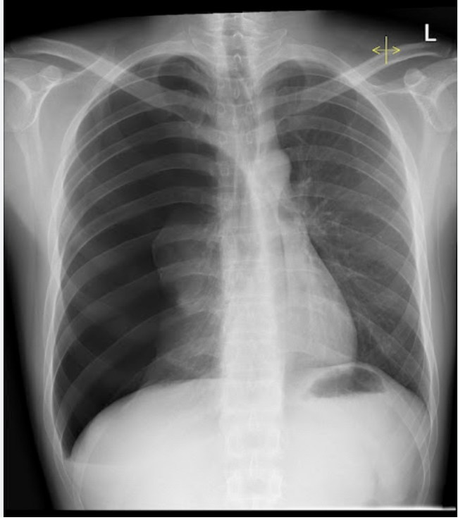 <p>What are some signs of a tension pneumothorax?</p>