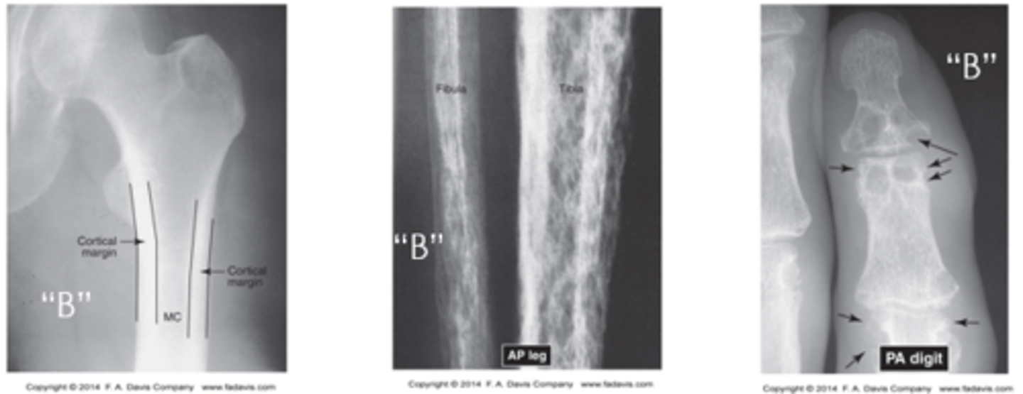<p>General Bone Density</p><p>- Contrast of soft tissue and bone (shades of grey)</p><p>- Contrast between cortical and cancellous bone</p><p>Textural Abnormalities</p><p>- Normal trabecular architecture</p><p>Local Bone Density Changes</p><p>- Sclerosis at areas of increased stress such as weight bearing surfaces or site of ligamentous, muscular, or tendon attachment</p>
