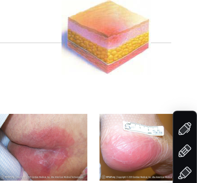 <p><strong>intact skin</strong></p><ul><li><p>Non-blanching erythema</p></li><li><p>Skin may be warm to touch and painful</p></li></ul><p></p>