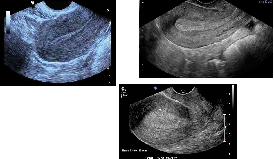 <p><strong><em>is the most common cause of abnormal uterine bleeding in</em></strong></p><p class="p2"><strong><em>both premenopausal and postmenopausal women.</em></strong> Hyperplasia develops from</p><p class="p1">unopposed estrogen stimulation.</p><p class="p2"> It appears as a thickening of the endometrium.</p><p class="p1"> In premenopausal women, if the endometrium measures more than 14 mm (double</p><p class="p2">thickness), hyperplasia is suggested.</p><p class="p1"> The optimal time period for this assessment in a woman still having menses is day 6</p><p class="p2">through day 10, after bleeding and before the endometrium is again stimulated.</p><p class="p1"> In asymptomatic postmenopausal women, 8 mm (double thickness) is the upper limit of</p><p class="p2">normal. However, women on sequential estrogen and progesterone replacement</p><p class="p1">regimens may have endometrial thickness up to 15 mm during the estrogen phase; the</p><p class="p2">thickness decreases after progesterone is added.</p><p class="p2"> Ideally a woman using <strong>sequential hormones </strong>should be studied at the <strong>beginning or</strong></p><p class="p1"><strong>end of her hormone cycle</strong>, when the endometrium is theoretically at its thinnest.</p><p class="p1"> <strong>Hyperplasia is less common during the reproductive years</strong>, but it may occur with</p><p class="p1">persistent anovulatory cycles, with polycystic ovarian disease, and in obese women</p><p class="p1">with increased production of endogenous estrogens.</p><p class="p1"> <strong>Hyperplasia may also be seen in women with estrogen-producing tumors</strong>, such</p><p class="p1">as granulose cell tumors and thecomas of the ovary.</p><p class="p1"> Because hyperplasia has a nonspecific sonographic appearance, an <strong><em>endometrial</em></strong></p><p class="p1"><strong><em>biopsy is necessary for diagnosis</em></strong>. Sonohysterography can also be performed to</p><p class="p1">evaluate the internal structure of the endometrial canal.</p><p class="p1"> Most women with postmenopausal uterine bleeding are experiencing endometrial</p><p class="p1">atrophy.</p><p class="p1"> On transvaginal sonography, <strong><em>an atrophic endometrium is thin, measuring less than</em></strong></p><p class="p1"><strong><em>5 mm.</em></strong></p><p class="p1"> If the postmenopausal patient has irregular bleeding and a thickened endometrium,</p><p class="p1">this may warrant a sonohysterography procedure or an endometrial biopsy.</p><p class="p1"> Ultrasound is used to help the clinician triage which patients are candidates for</p><p class="p1">biopsy. Clinicians may use the endometrial measurement alone (for example, greater</p><p class="p1">than 5 to 8 mm without bleeding), or they may use symptoms as their criteria (for</p><p class="p1">example, less than 5 to 8 mm with bleeding).</p><p class="p1">Sonographic Findings</p><p class="p2"> The endometrium is usually diffusely thick and echogenic with well-defined margins.</p><p class="p2"> Focal or asymmetric thickening can occur. Small cysts representing dilated cystic</p><p class="p2">glands may be seen within the endometrium.</p><p class="p2"> Although cystic changes within a thickened endometrium are more frequently</p><p class="p2">witnessed in benign conditions, they can also be observed in endometrial carcinoma.</p>