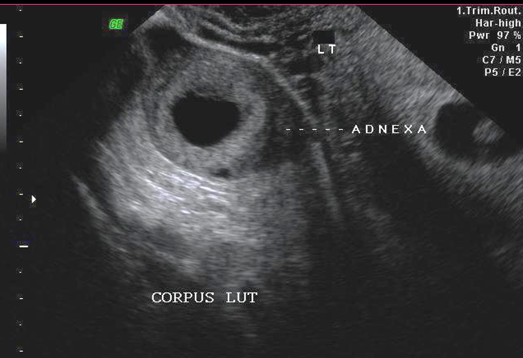 <p>Corpus luteum cysts usually appear as _____ masses with central _____ _____ and _____</p>