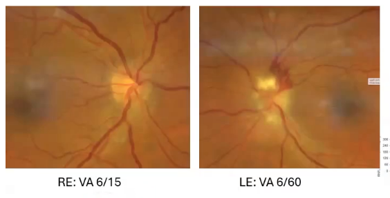 <p>other athologies: optic neuritis </p>